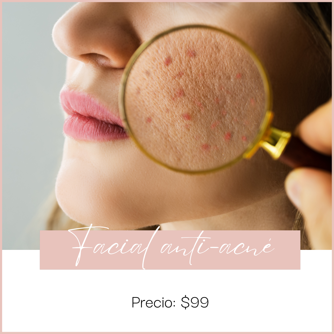 Facial anti-acné - Depósito de